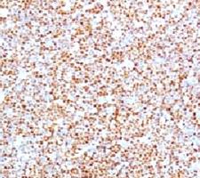 CCND1 / Cyclin D1 Antibody - IHC testing of human mantle cell lymphoma and Cyclin D1 antibody (BCLD1-1).  This image was taken for the unmodified form of this product. Other forms have not been tested.
