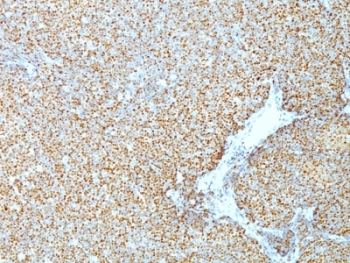 CCND1 / Cyclin D1 Antibody - Formalin-fixed, paraffin-embedded human mantle cell lymphoma stained with Cyclin D1 antibody (CCND1/809).  This image was taken for the unmodified form of this product. Other forms have not been tested.