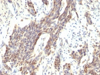 CCND1 / Cyclin D1 Antibody - Formalin-fixed, paraffin-embedded human bladder carcinoma stained with Cyclin D1 antibody (CCND1/809).  This image was taken for the unmodified form of this product. Other forms have not been tested.