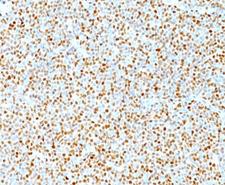CCND1 / Cyclin D1 Antibody - Cyclin D1 antibody immunohistochemistry.  This image was taken for the unmodified form of this product. Other forms have not been tested.