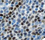 CCND1 / Cyclin D1 Antibody - IHC of Cyclin D1 on FFPE Mantle Cell Lymphoma tissue.