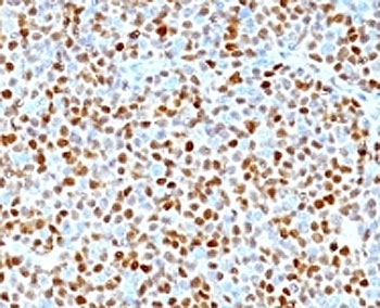 CCND1 / Cyclin D1 Antibody - Formalin-fixed, paraffin-embedded human mantle cell lymphoma stained with CCND1 antibody (clone SPM587).  This image was taken for the unmodified form of this product. Other forms have not been tested.