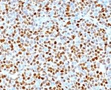 CCND1 / Cyclin D1 Antibody - Formalin-fixed, paraffin-embedded human mantle cell lymphoma stained with CCND1 antibody (clone SPM587).  This image was taken for the unmodified form of this product. Other forms have not been tested.