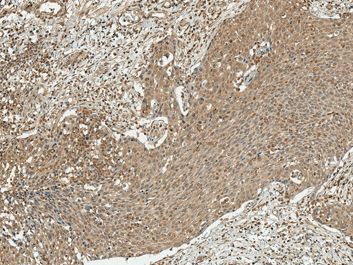 CCND1 / Cyclin D1 Antibody - Immunohistochemistry analysis using Rabbit Anti-Cyclin D1 Polyclonal Antibody. Tissue: Esophagus. Species: Human. Fixation: Formalin Fixed Paraffin-Embedded. Primary Antibody: Rabbit Anti-Cyclin D1 Polyclonal Antibody  at 1:50 for 30 min at RT. Counterstain: Hematoxylin. Magnification: 10X. HRP-DAB Detection.