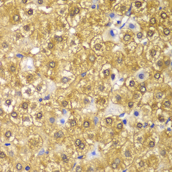 CCND1 / Cyclin D1 Antibody - Immunohistochemistry of paraffin-embedded human liver cancer using CCND1 antibodyat dilution of 1:100 (40x lens).