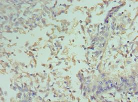 CCND2 / Cyclin D2 Antibody - Immunohistochemistry of paraffin-embedded human cervical cancer using antibody at 1:100 dilution.
