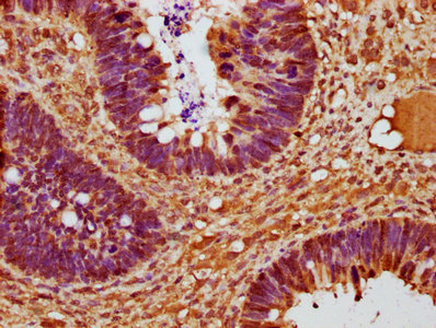 CCND2 / Cyclin D2 Antibody - IHC image of CCND2 Antibody diluted at 1:225 and staining in paraffin-embedded human ovarian cancer performed on a Leica BondTM system. After dewaxing and hydration, antigen retrieval was mediated by high pressure in a citrate buffer (pH 6.0). Section was blocked with 10% normal goat serum 30min at RT. Then primary antibody (1% BSA) was incubated at 4°C overnight. The primary is detected by a biotinylated secondary antibody and visualized using an HRP conjugated SP system.