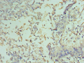 CCND2 / Cyclin D2 Antibody - Immunohistochemistry of paraffin-embedded human cervical cancer using CCND2 Antibody at dilution of 1:100