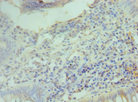 CCND2 / Cyclin D2 Antibody - Immunohistochemistry of paraffin-embedded human colon cancer using CCND2 Antibody at dilution of 1:100