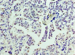 CCND3 / Cyclin D3 Antibody - Immunohistochemistry of paraffin-embedded human lung cancer using antibody at 1:100 dilution.