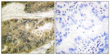 CCND3 / Cyclin D3 Antibody - Immunohistochemistry analysis of paraffin-embedded human lung carcinoma tissue, using Cyclin D3 Antibody. The picture on the right is blocked with the synthesized peptide.