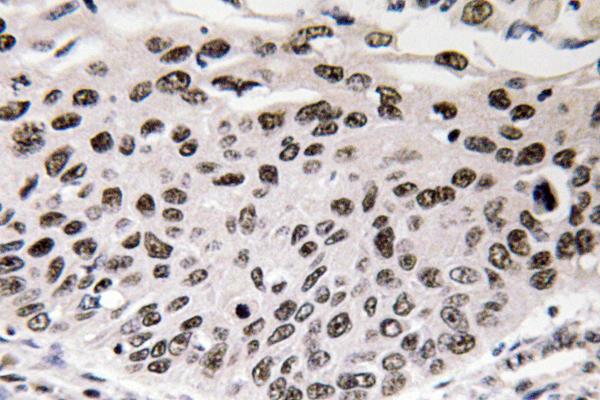 CCND3 / Cyclin D3 Antibody - IHC of Cyclin D3 (G277) pAb in paraffin-embedded human lung carcinoma tissue.