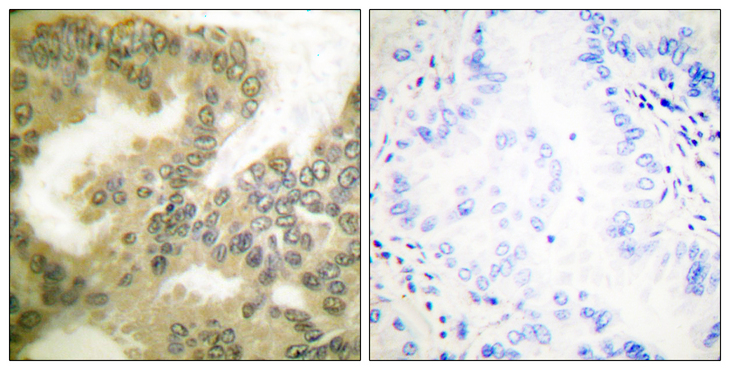 CCND3 / Cyclin D3 Antibody - Immunohistochemistry analysis of paraffin-embedded human lung carcinoma, using Cyclin D3 (Phospho-Thr283) Antibody. The picture on the right is blocked with the phospho peptide.