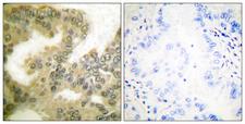CCND3 / Cyclin D3 Antibody - P-peptide - + Immunohistochemical analysis of paraffin-embedded human lung carcinoma tissue using Cyclin D3 (Phospho-Thr283) Antibody.