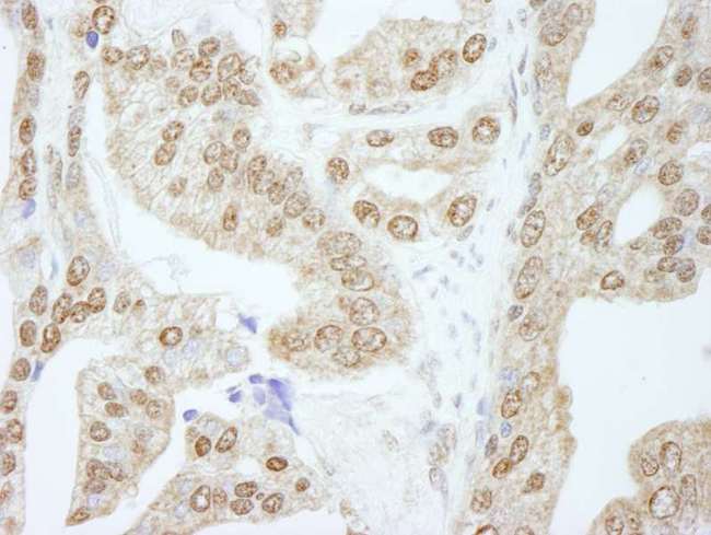 CCNE1 / Cyclin E1 Antibody - Detection of Human Cyclin E1 by Immunohistochemistry. Sample: FFPE section of human prostate carcinoma. Antibody: Affinity purified rabbit anti-Cyclin E1 used at a dilution of 1:250.