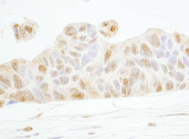 CCNE1 / Cyclin E1 Antibody - Detection of Human Cyclin E1 by Immunohistochemistry. Sample: FFPE section of human ovarian carcinoma. Antibody: Affinity purified rabbit anti-Cyclin E1 used at a dilution of1:200 (1 ug/ml). Detection: DAB.