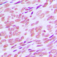 CCNE1 / Cyclin E1 Antibody - Immunohistochemical analysis of Cyclin E1 staining in human breast cancer formalin fixed paraffin embedded tissue section. The section was pre-treated using heat mediated antigen retrieval with sodium citrate buffer (pH 6.0). The section was then incubated with the antibody at room temperature and detected using an HRP conjugated compact polymer system. DAB was used as the chromogen. The section was then counterstained with hematoxylin and mounted with DPX.