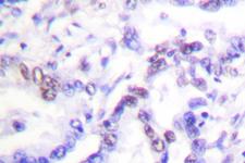 CCNE1 / Cyclin E1 Antibody - IHC of Cyclin E1 (I119) pAb in paraffin-embedded human lung carcinoma tissue.