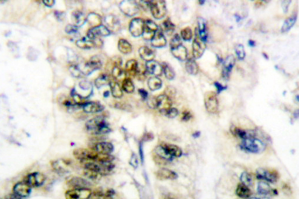 CCNE1 / Cyclin E1 Antibody - IHC of Cyclin E1 (L389) pAb in paraffin-embedded human colon carcinoma tissue.