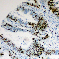 CCNE1 / Cyclin E1 Antibody - Immunohistochemical analysis of Cyclin E1 (pT395) staining in human colon cancer formalin fixed paraffin embedded tissue section. The section was pre-treated using heat mediated antigen retrieval with sodium citrate buffer (pH 6.0). The section was then incubated with the antibody at room temperature and detected using an HRP conjugated compact polymer system. DAB was used as the chromogen. The section was then counterstained with hematoxylin and mounted with DPX.