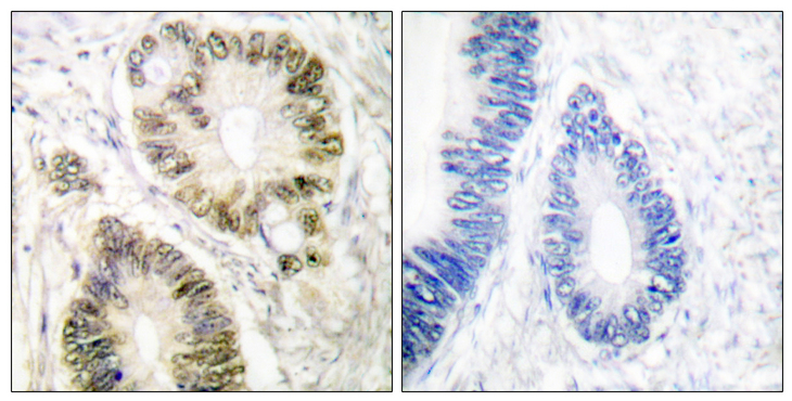 CCNE1 / Cyclin E1 Antibody - Immunohistochemical of paraffin-embedded human colon carcinoma tissue using Cyclin E1 (phospho-Thr395) antibody
