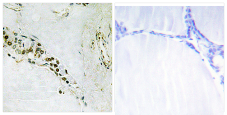 CCNE2 / Cyclin E2 Antibody - Immunohistochemistry analysis of paraffin-embedded human thyroid gland tissue, using Cyclin E2 Antibody. The picture on the right is blocked with the synthesized peptide.