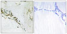 CCNE2 / Cyclin E2 Antibody - Immunohistochemistry analysis of paraffin-embedded human thyroid gland tissue, using Cyclin E2 Antibody. The picture on the right is blocked with the synthesized peptide.