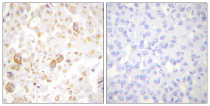 CCNF / Cyclin F Antibody - Immunohistochemistry analysis of paraffin-embedded human breast carcinoma tissue, using Cyclin F Antibody. The picture on the right is blocked with the synthesized peptide.