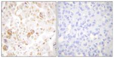 CCNF / Cyclin F Antibody - Peptide - + Immunohistochemical analysis of paraffin-embedded human breast carcinoma tissue using Cyclin F antibody.