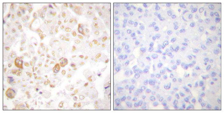 CCNF / Cyclin F Antibody - Peptide - + Immunohistochemical analysis of paraffin-embedded human breast carcinoma tissue using Cyclin F antibody.