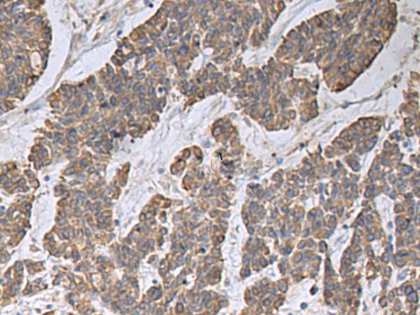 CCNF / Cyclin F Antibody - Immunohistochemistry of paraffin-embedded Human colorectal cancer tissue  using CCNF Polyclonal Antibody at dilution of 1:30(×200)