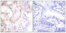 CCNG1 / Cyclin G1 Antibody - Immunohistochemistry analysis of paraffin-embedded human lung carcinoma tissue, using Cyclin G Antibody. The picture on the right is blocked with the synthesized peptide.