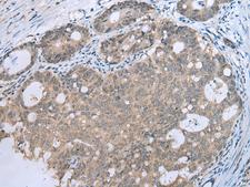 CCNG1 / Cyclin G1 Antibody - Immunohistochemistry of paraffin-embedded Human gastric cancer tissue  using CCNG1 Polyclonal Antibody at dilution of 1:30(×200)