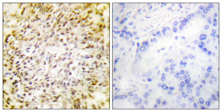 CCNH / Cyclin H Antibody - Peptide - + Immunohistochemistry analysis of paraffin-embedded human lung carcinoma tissue using Cyclin H (Ab-315) antibody.