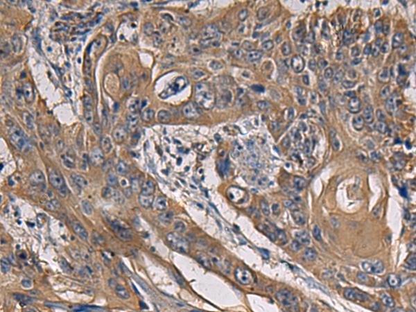 CCNI / Cyclin I Antibody - Immunohistochemistry of paraffin-embedded Human esophagus cancer tissue  using CCNI Polyclonal Antibody at dilution of 1:65(×200)