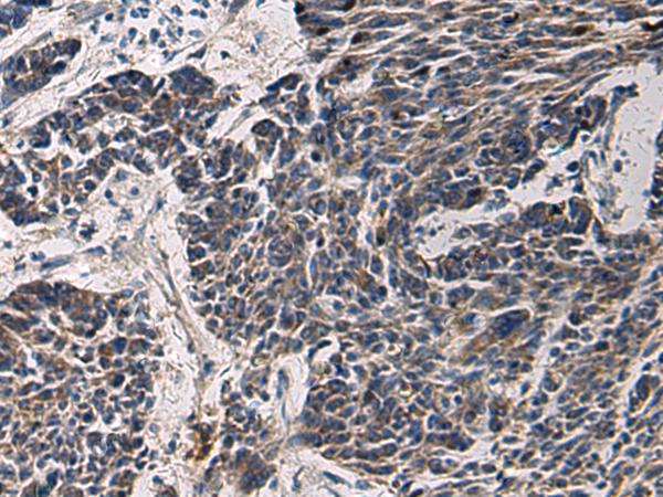 CCNI / Cyclin I Antibody - Immunohistochemistry of paraffin-embedded Human colorectal cancer tissue  using CCNI Polyclonal Antibody at dilution of 1:65(×200)