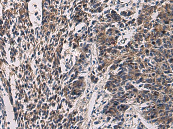 CCNI / Cyclin I Antibody - Immunohistochemistry of paraffin-embedded Human colorectal cancer tissue  using CCNI Polyclonal Antibody at dilution of 1:60(×200)