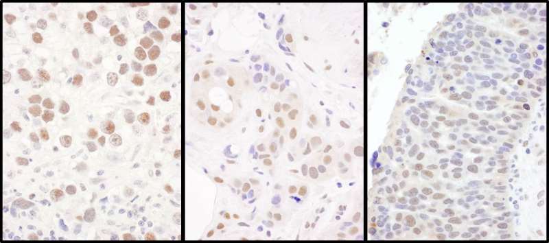 CCNK Antibody - Detection of Human K by Immunohistochemistry. Sample: FFPE sections of human testicular seminoma (left), breast carcinoma (center) and ovarian carcinoma (right). Antibody: Affinity purified rabbit anti-K used at a dilution of 1:1000 (1 Detection: DAB.