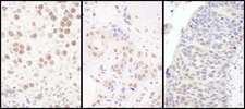 CCNK Antibody - Detection of Human K by Immunohistochemistry. Sample: FFPE sections of human testicular seminoma (left), breast carcinoma (center) and ovarian carcinoma (right). Antibody: Affinity purified rabbit anti-K used at a dilution of 1:1000 (1 Detection: DAB.