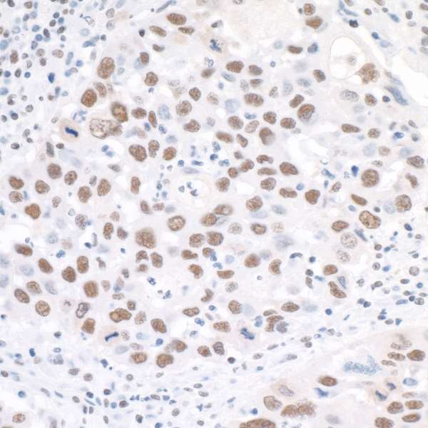CCNK Antibody - Detection of human Cyclin K by immunohistochemistry. Sample: FFPE section of human head and neck squamous cell carcinoma. Antibody: Affinity purified rabbit anti-Cyclin K used at a dilution of 1:5,000 (0.2µg/ml). Detection: DAB