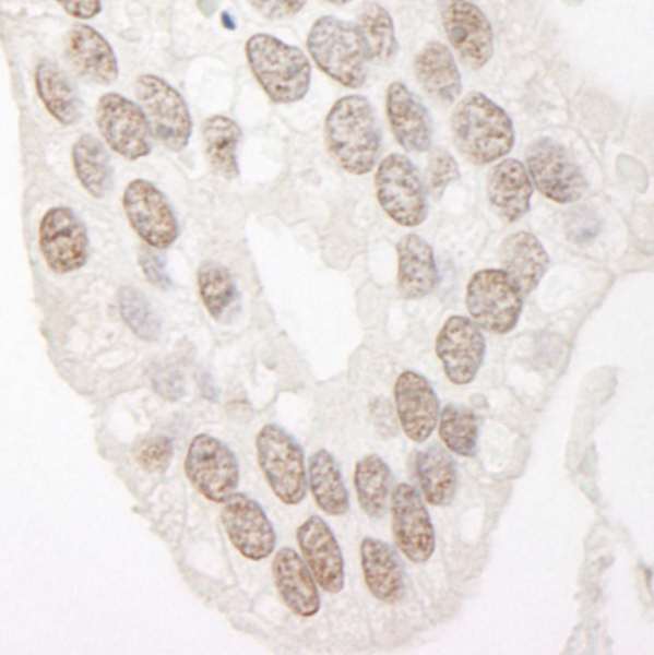 CCNL1 / Cyclin L1 Antibody - Detection of Human Cyclin L1 by Immunohistochemistry. Sample: FFPE section of human prostate carcinoma. Antibody: Affinity purified rabbit anti-Cyclin L1 used at a dilution of 1:500. Epitope Retrieval Buffer-High pH (IHC-101J) was substituted for Epitope Retrieval Buffer-Reduced pH.