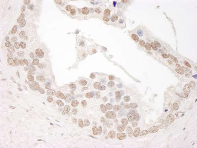 CCNL1 / Cyclin L1 Antibody - Detection of Human Cyclin L1 by Immunohistochemistry. Sample: FFPE section of human prostate carcinoma. Antibody: Affinity purified rabbit anti-Cyclin L1 used at a dilution of1:1000 (1 ug/ml). Detection: DAB.