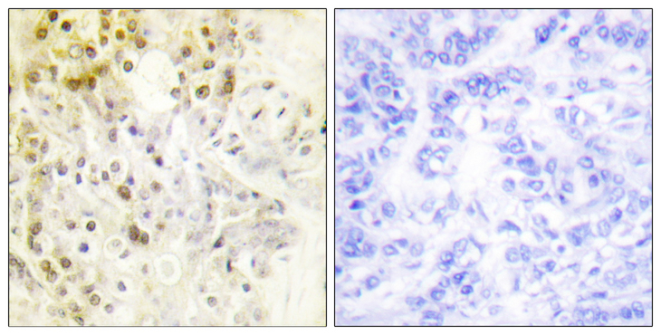 CCNL1 / Cyclin L1 Antibody - Immunohistochemistry analysis of paraffin-embedded human breast carcinoma tissue, using Cyclin L1 Antibody. The picture on the right is blocked with the synthesized peptide.