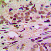 CCNL1 / Cyclin L1 Antibody - Immunohistochemical analysis of Cyclin L1 staining in human breast cancer formalin fixed paraffin embedded tissue section. The section was pre-treated using heat mediated antigen retrieval with sodium citrate buffer (pH 6.0). The section was then incubated with the antibody at room temperature and detected using an HRP conjugated compact polymer system. DAB was used as the chromogen. The section was then counterstained with hematoxylin and mounted with DPX.