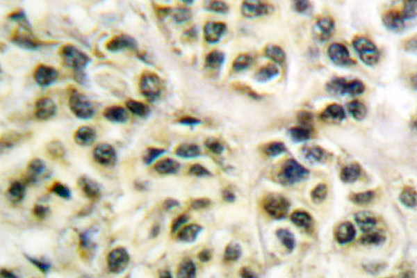 CCNL1 / Cyclin L1 Antibody - IHC of Cyclin-L1 (E491) pAb in paraffin-embedded human breast carcinoma lung carcinoma tissue.