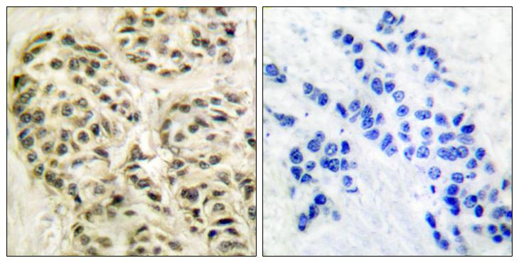 CCNL1 / Cyclin L1 Antibody - Peptide - + Immunohistochemical analysis of paraffin-embedded human breast carcinoma tissue using Cyclin-L1 antibody.