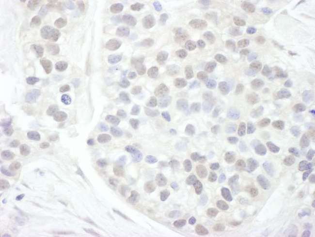 CCNT1 / Cyclin T1 Antibody - Detection of Human Cyclin T1 by Immunohistochemistry. Sample: FFPE section of human breast carcinoma. Antibody: Affinity purified rabbit anti-Cyclin T1 used at a dilution of 1:200 (1 ug/ml). Detection: DAB.