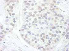 CCNT1 / Cyclin T1 Antibody - Detection of Human Cyclin T1 by Immunohistochemistry. Sample: FFPE section of human breast carcinoma. Antibody: Affinity purified rabbit anti-Cyclin T1 used at a dilution of 1:200 (1 ug/ml). Detection: DAB.