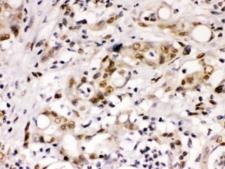 CCNT1 / Cyclin T1 Antibody - IHC testing of FFPE human intestine cancer tissue with Cyclin T1 antibody at 1ug/ml. HIER: steam in pH6 citrate buffer and allow to cool prior to staining.