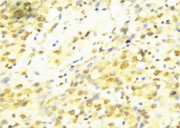 CCNT1 / Cyclin T1 Antibody - 1:100 staining human breast carcinoma tissue by IHC-P. The sample was formaldehyde fixed and a heat mediated antigen retrieval step in citrate buffer was performed. The sample was then blocked and incubated with the antibody for 1.5 hours at 22°C. An HRP conjugated goat anti-rabbit antibody was used as the secondary.
